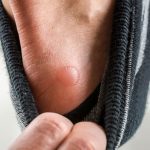 Blisters need to know